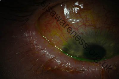 Right Eye - 24 year old male who suffered Toxic Epidermal Necrolysis Syndrome with severe Ocular involvement. Photo was taken 2 years after the initial TEN reaction (2)